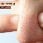 sondakika-burundaki-siyah-noktalar-nasil-gecer?-evde-dogal-cozumler